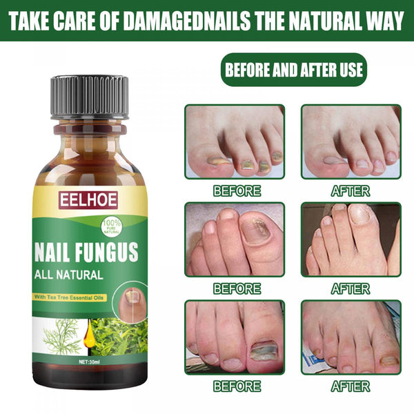 【30ml】EELHOE  茶樹油腳甲護理液 腳甲受傷護理液 EELHOE Nail Repair Solution with Tea Tree Oil for Discolored and Damaged