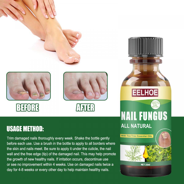 【30ml】EELHOE  茶樹油腳甲護理液 腳甲受傷護理液 EELHOE Nail Repair Solution with Tea Tree Oil for Discolored and Damaged